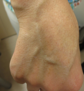 レーザー 手の甲 シミ 意外とできやすい？手の甲のシミの予防方法と治療法