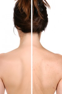 Left: smooth skin after treatment - right pimples bad skin