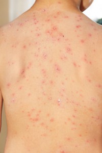 Baby boy with chicken pox rash