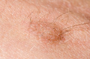 Hairy skin tag on a persons skin close up