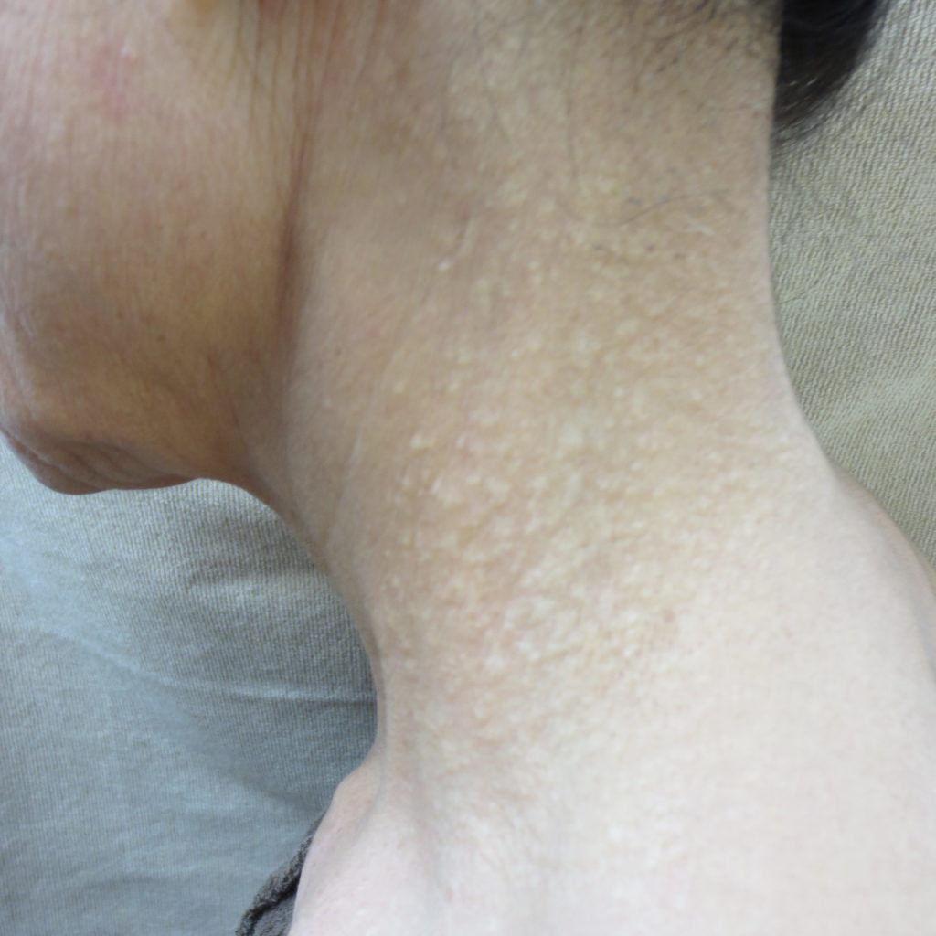 汗管腫・エクリン汗のう腫 ページ 3 八丁堀 皮膚科|スキンソリューションクリニック 汗管腫・エクリン汗のう腫 ページ 3 八丁堀 皮膚科|スキンソリューションクリニック