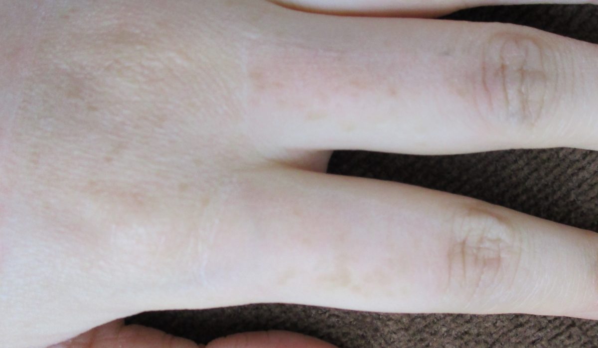 汗管腫・エクリン汗のう腫 ページ 2 八丁堀 皮膚科|スキンソリューションクリニック 汗管腫・エクリン汗のう腫 ページ 2 八丁堀 皮膚科|スキンソリューションクリニック