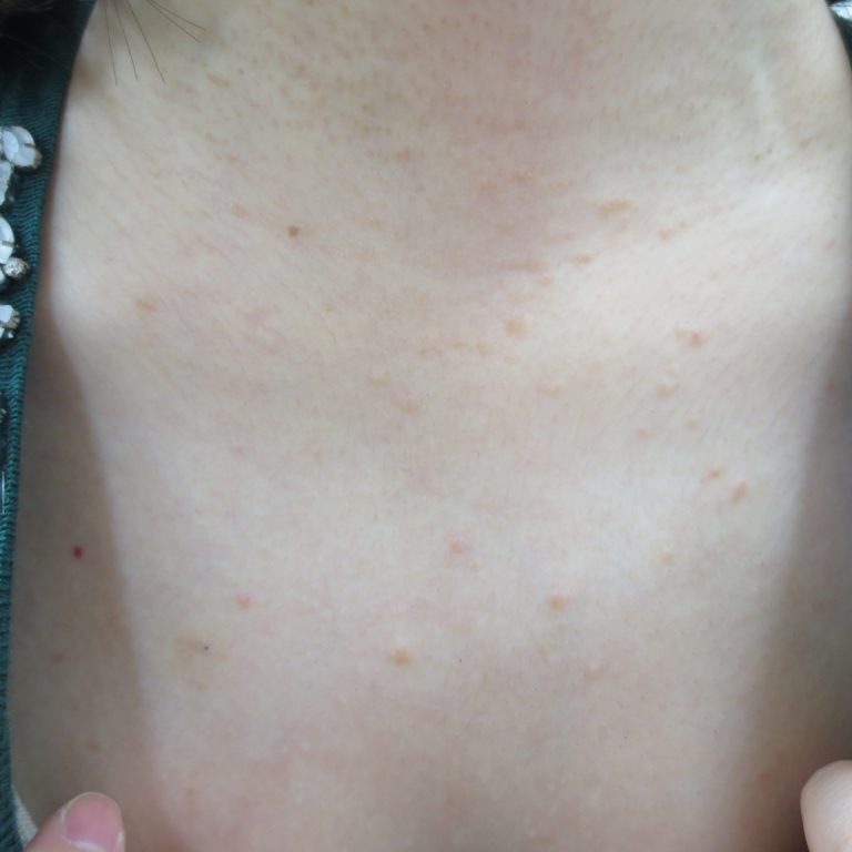 汗管腫・エクリン汗のう腫 ページ 2 八丁堀 皮膚科|スキンソリューションクリニック 汗管腫・エクリン汗のう腫 ページ 2 八丁堀 皮膚科|スキンソリューションクリニック